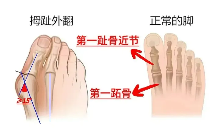 夏天穿凉鞋怕露