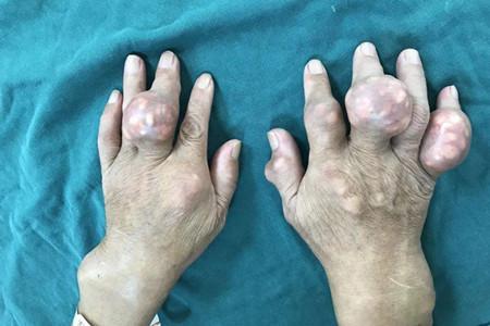 痛风石：藏在身体里的 “小石头”，你了解多少?