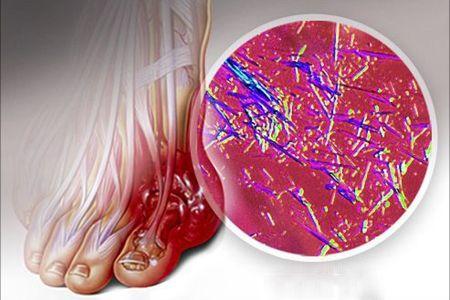 别让尿酸盐结晶 “悄悄” 伤害你!这份日常防护指南请收好