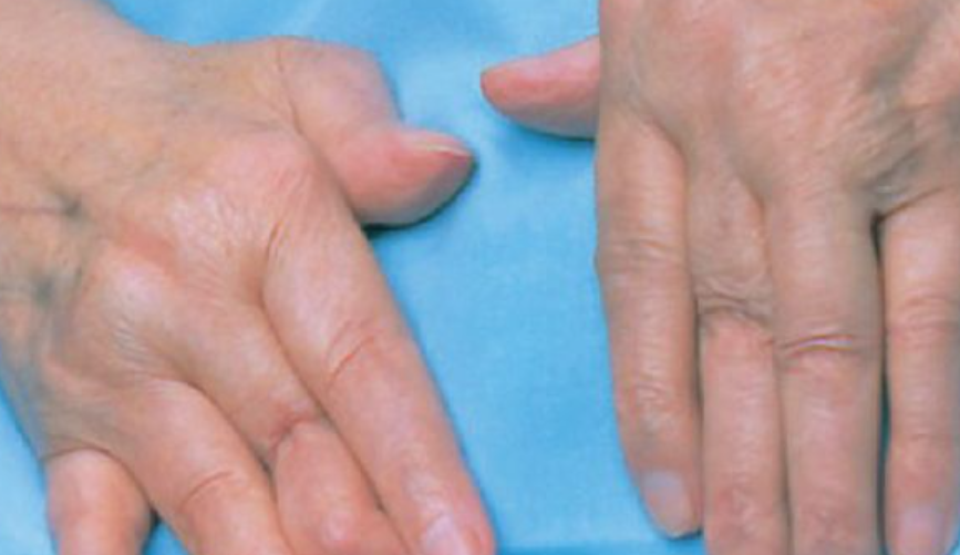 开年送安康|原北京301医院潘秀臣教授带队，为风湿痛风患者排忧解难